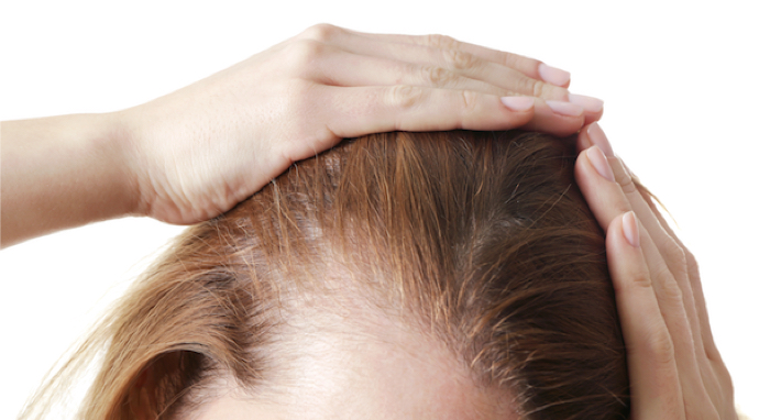 images-calvitie-motifs