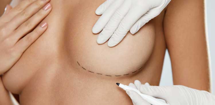Augmentation mammaire par mastopexie, ou lifting des seins