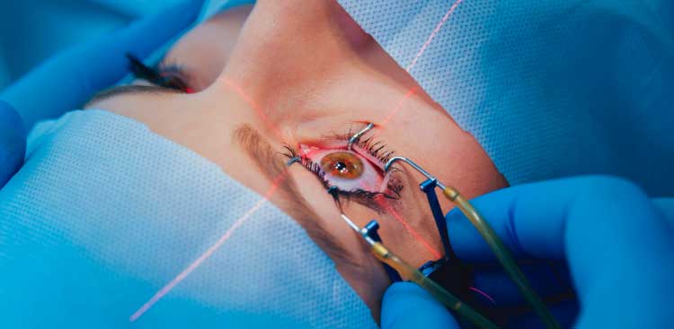 greffe intralase lasik body expert