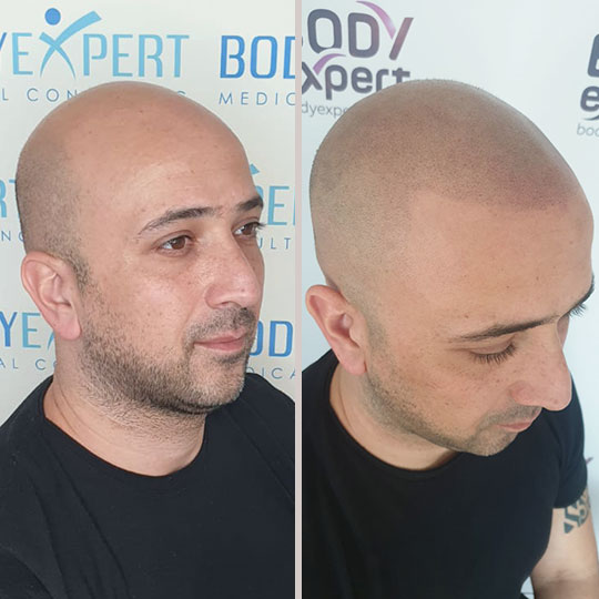 Photo03-Micropigmentation-BodyExpert