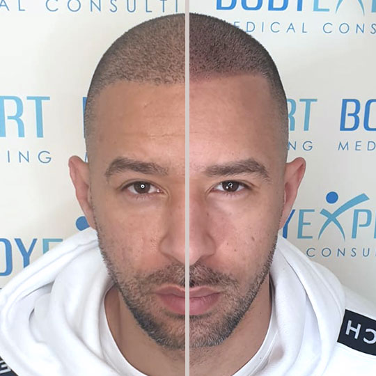 Photo05-Micropigmentation-BodyExpert