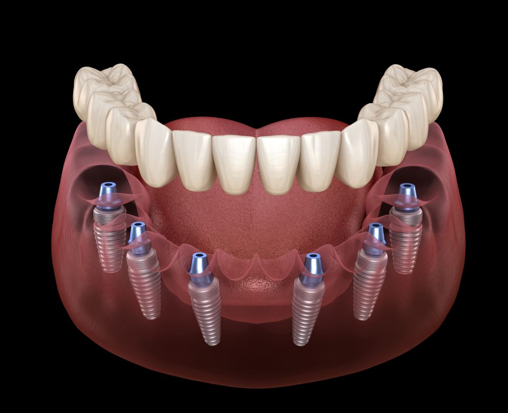  A 3D modelisation of All-on-6