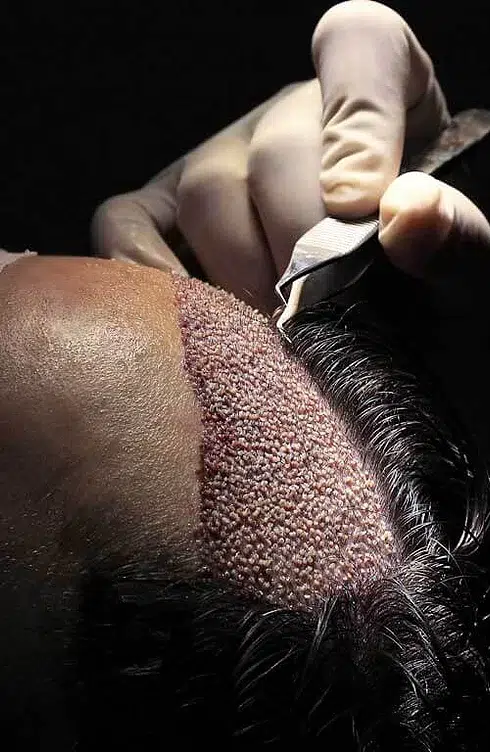 greffe-cheveux-fue-lame-sapphire