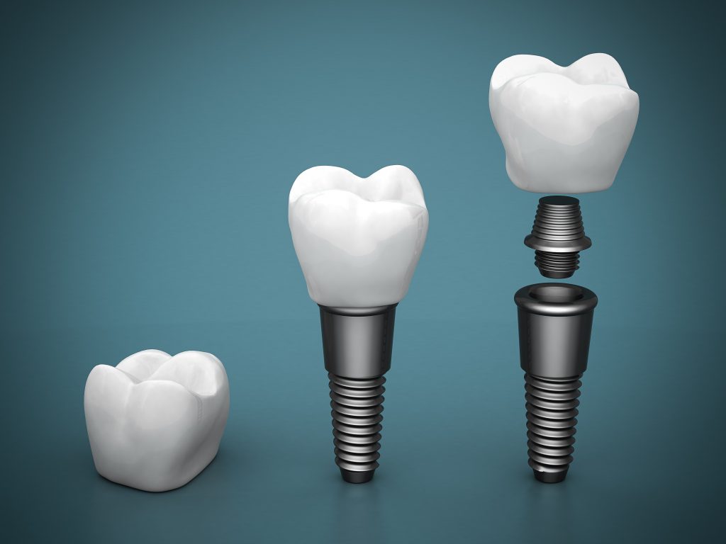 Modélisation 3D de prothèses dentaires fixées sur des ancrages en titane All-On-6