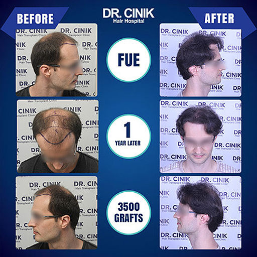 Resultat-1-an-greffe-de-cheveux-FUE-3500 (1)