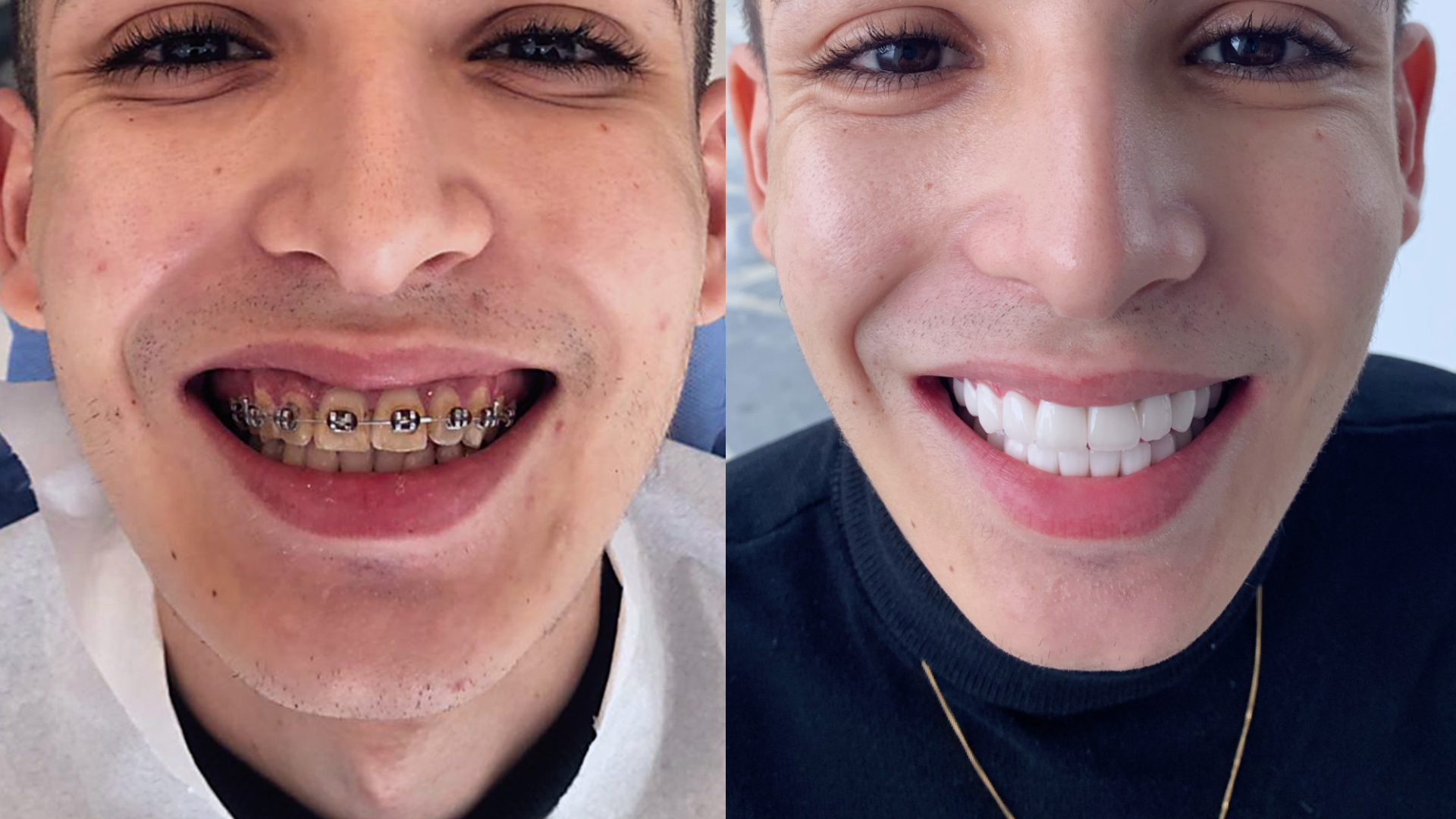 Pose de couronne de dentaires en Turquie : Avant / Après