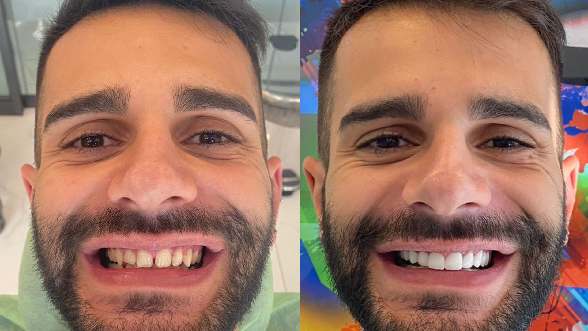 Dental crowns in Turkey results