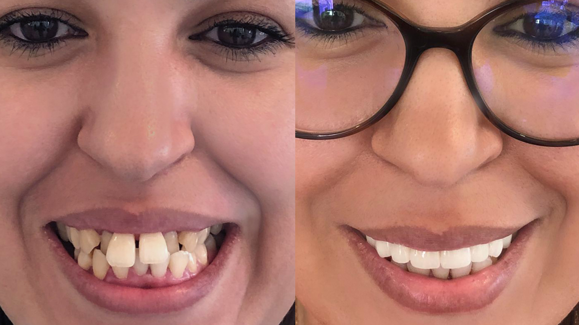 Procédure Hollywood Smile, avec pose de couronnes dentaire : avant - après