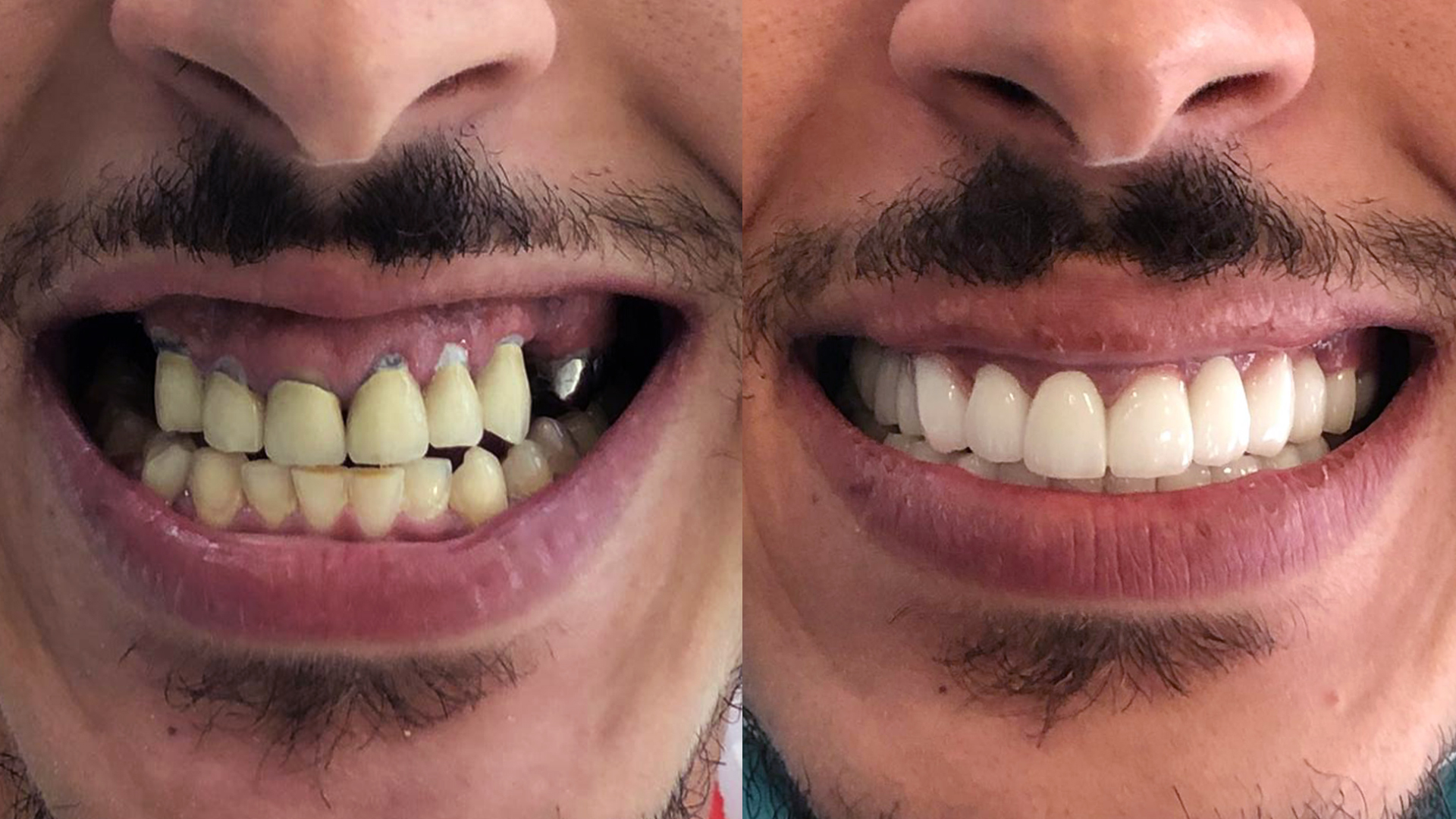 pose de couronne dentaire en Zircone finition Emax avant après