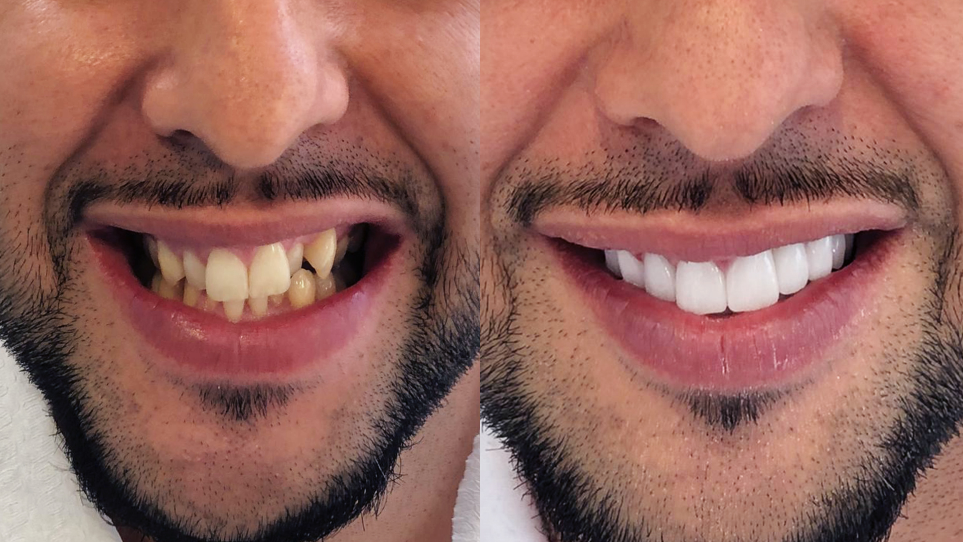 Pose de couronne dentaires en Turquie : avant - après