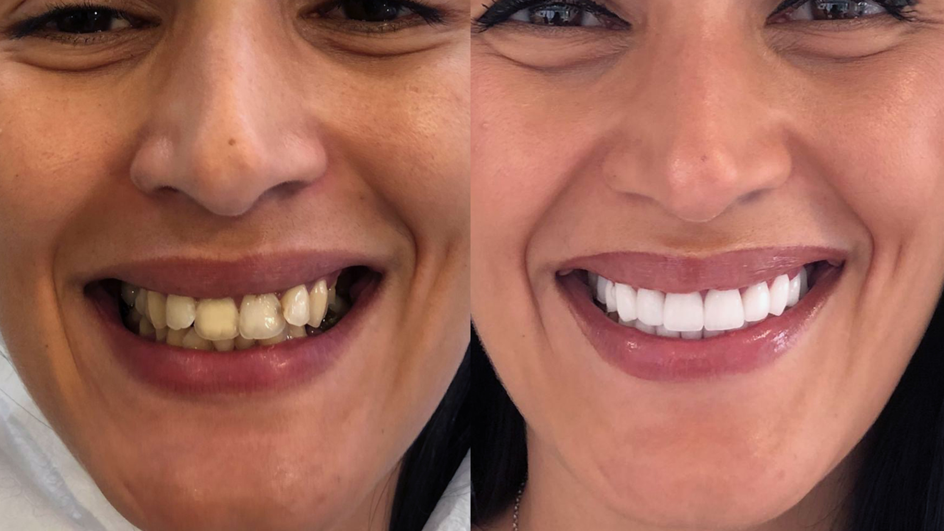 Zirconia crowns in Turkey Before after