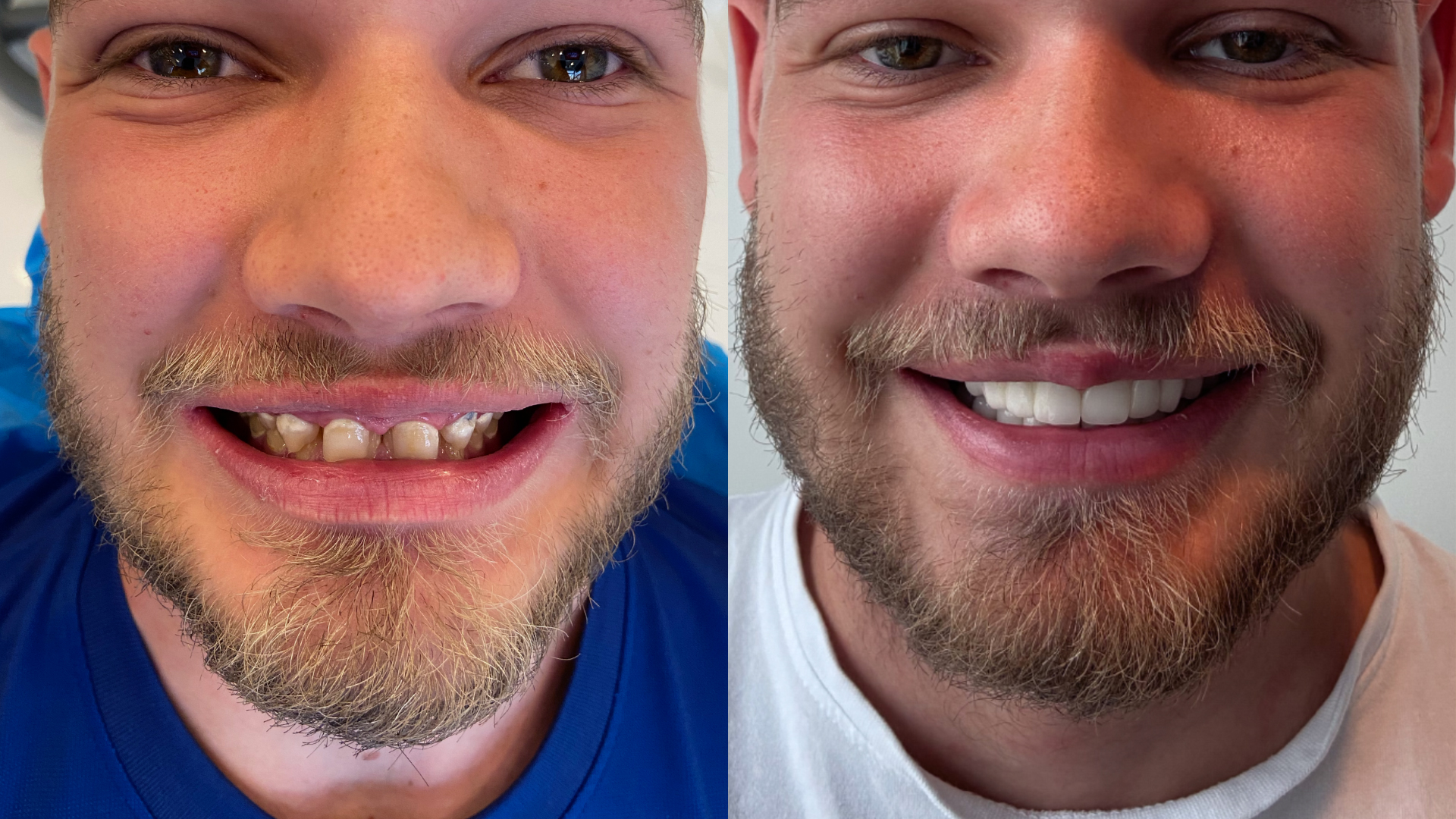 Before and After a Hollywood smile