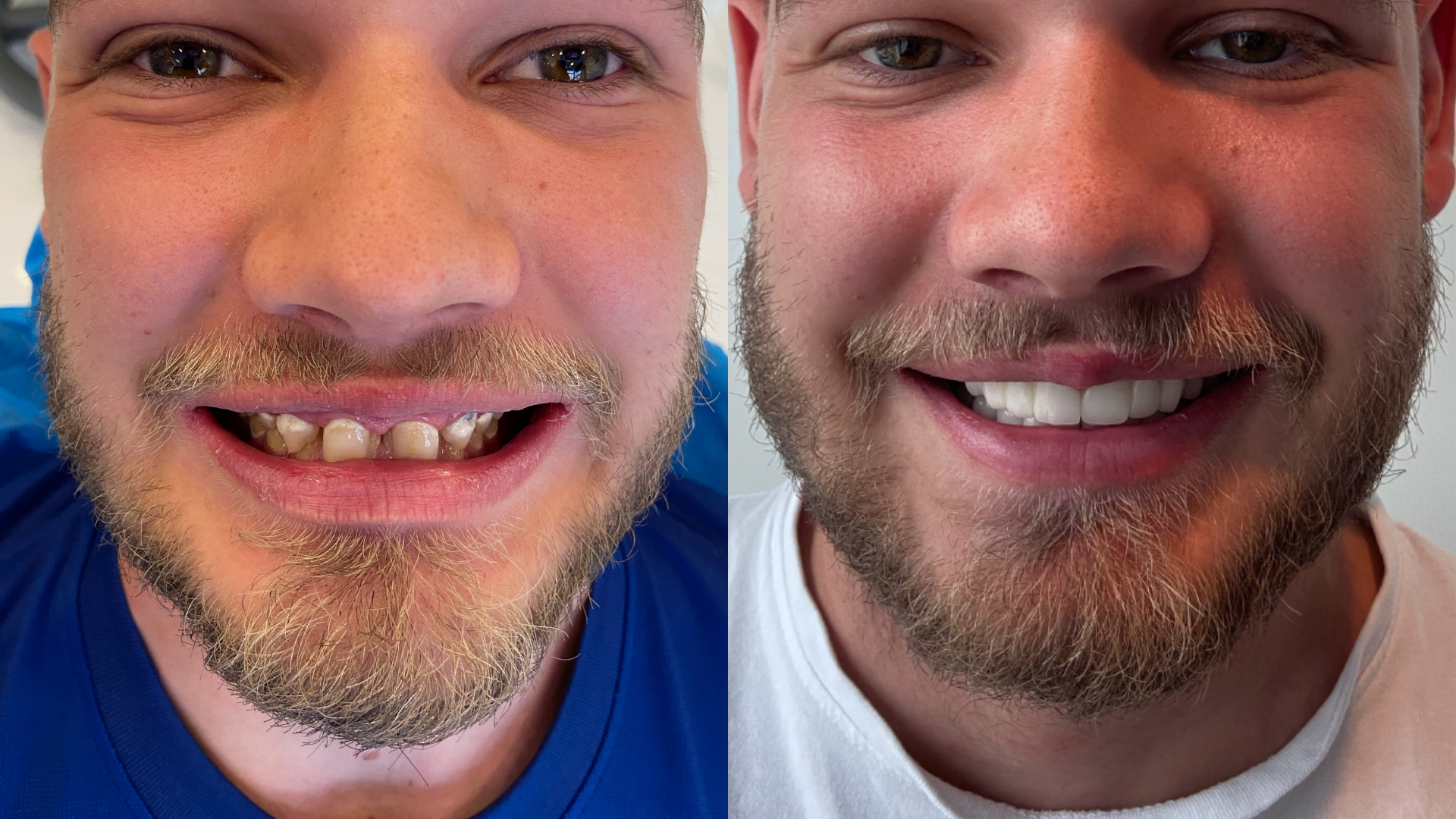 L’approche Hollywood Smile en dentisterie esthétique : les résultats