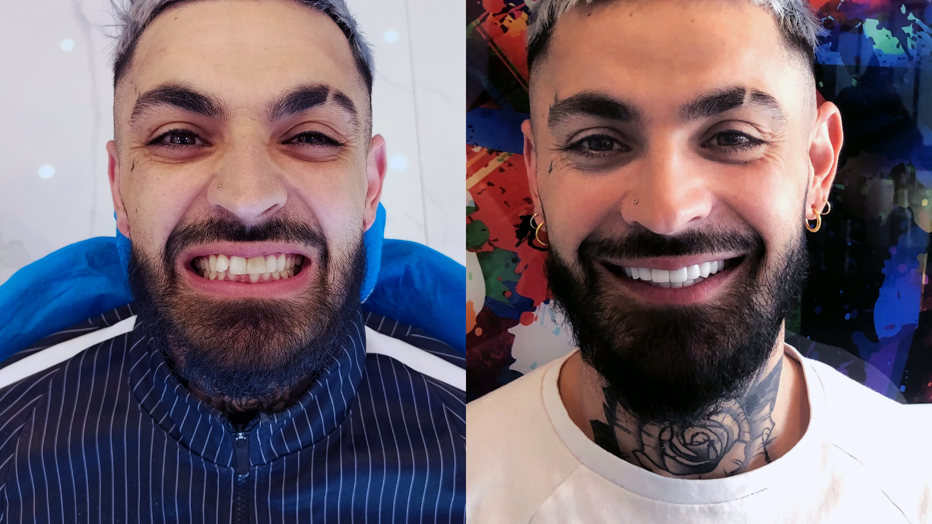 Facettes Dentaires : Avant / Après