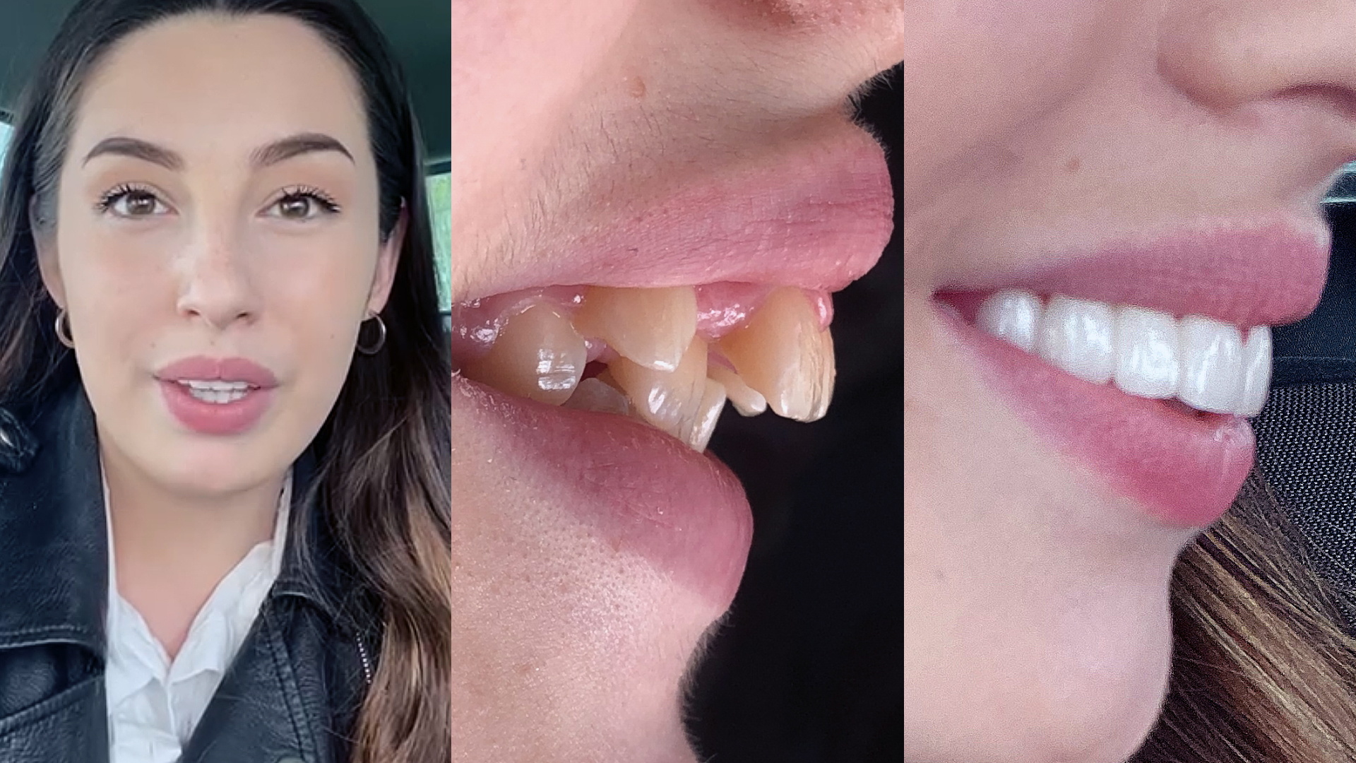 Hollywood Smile : before and after