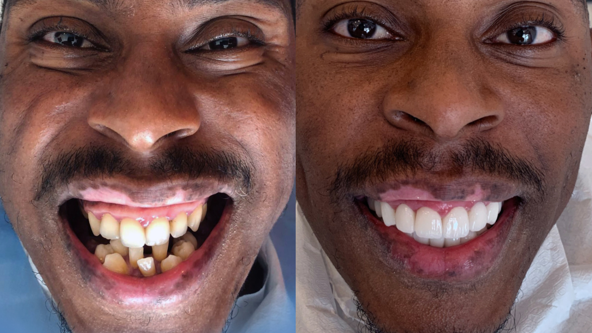 Exemple d’amélioration globale de la dentition grâce à la dentisterie esthétique
