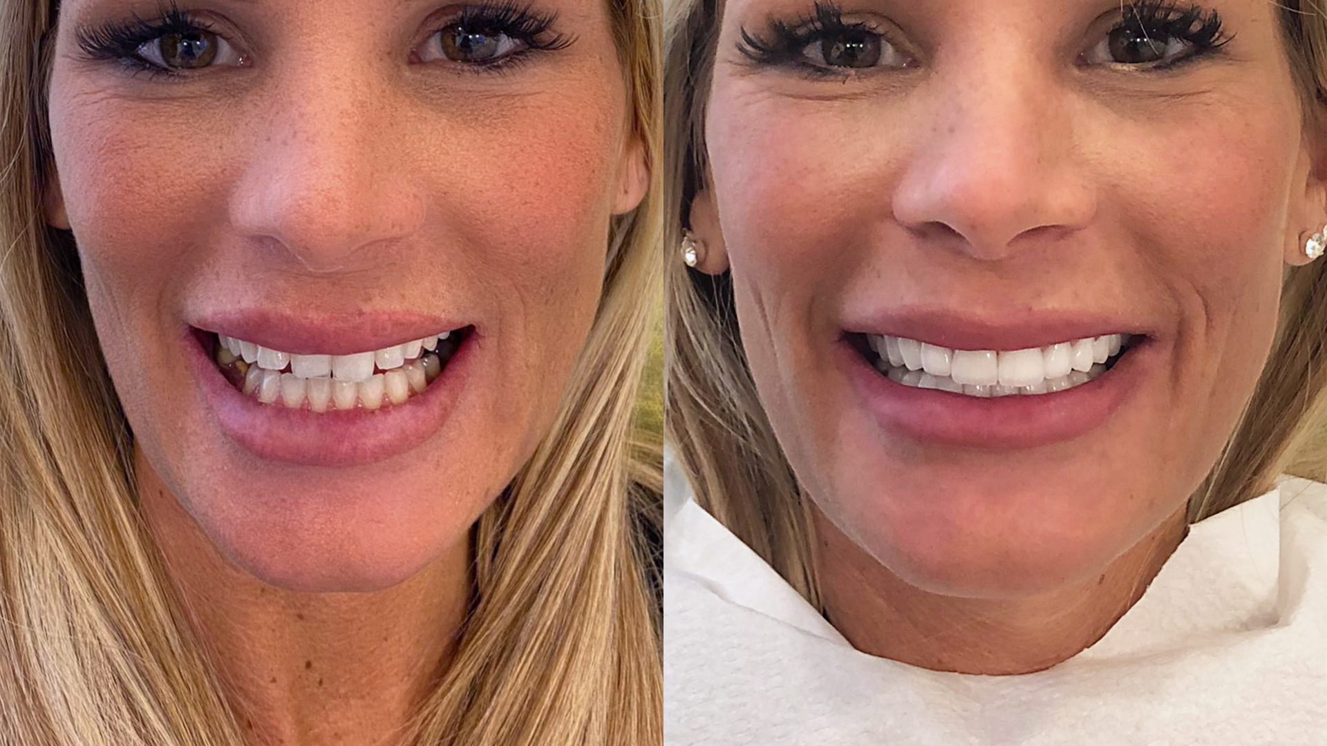 a bright and flawless smile thanks to Hollywood Smile