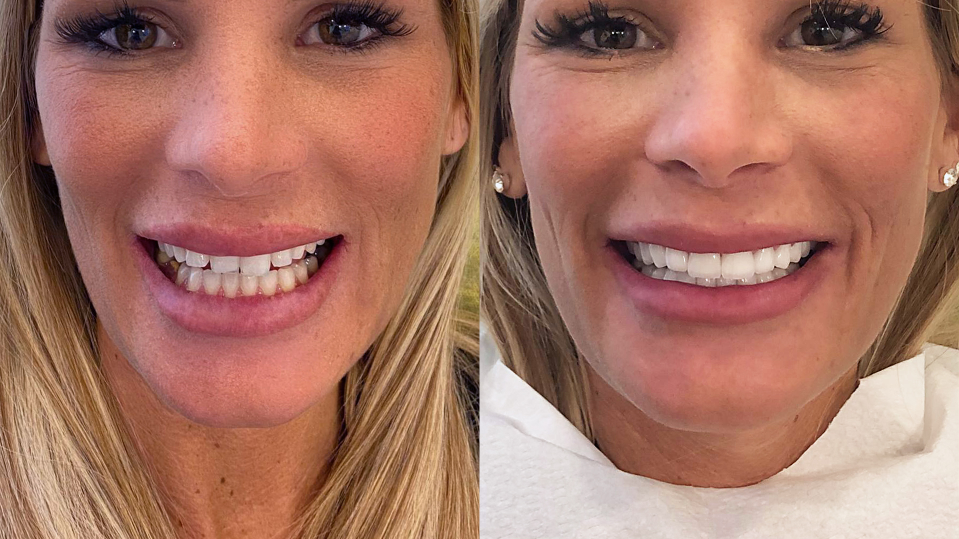 Avant et Après un Hollywood Smile à Istanbul