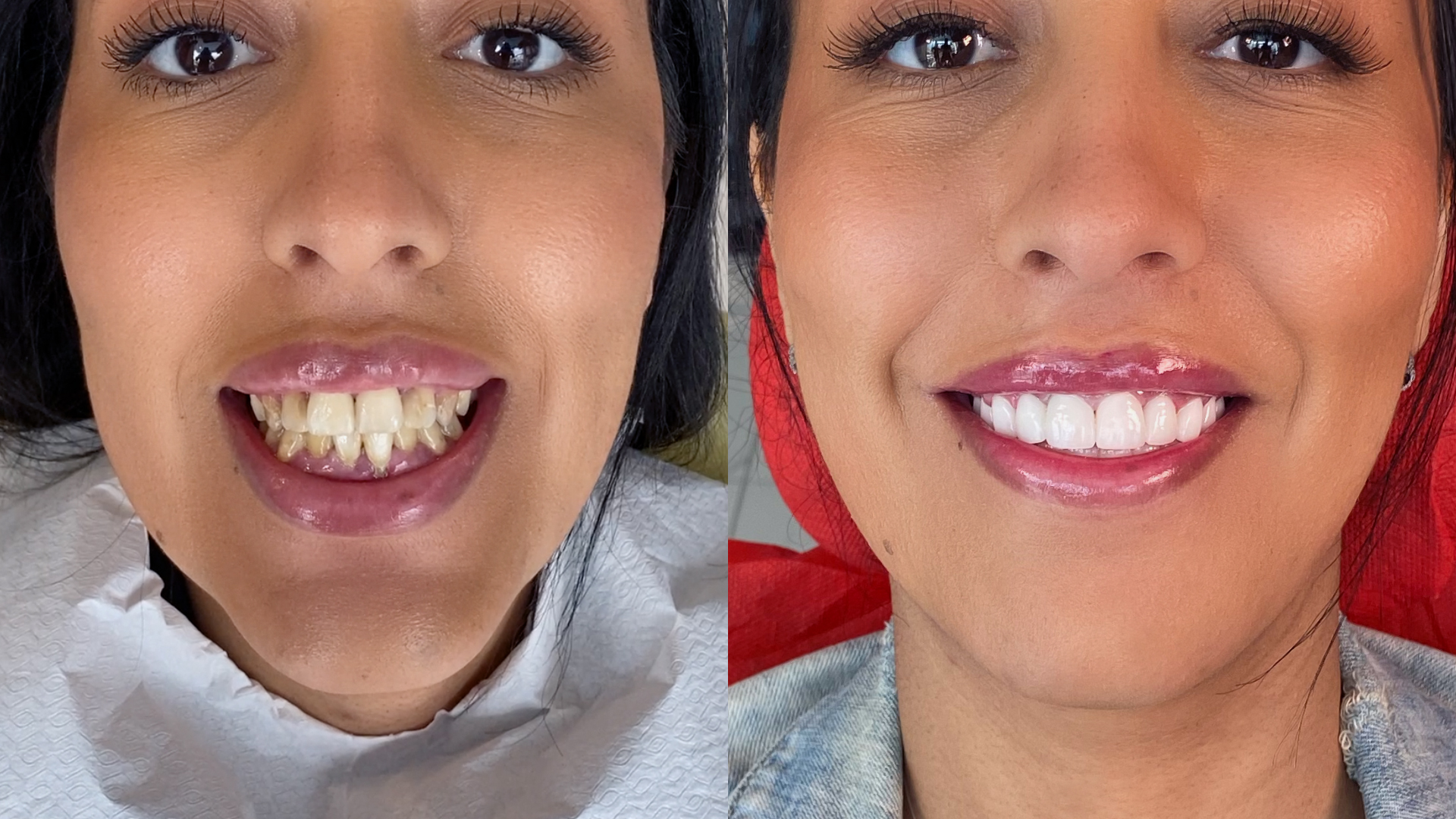 Before and after the placement of dental veneers and other cosmetic surgery interventions