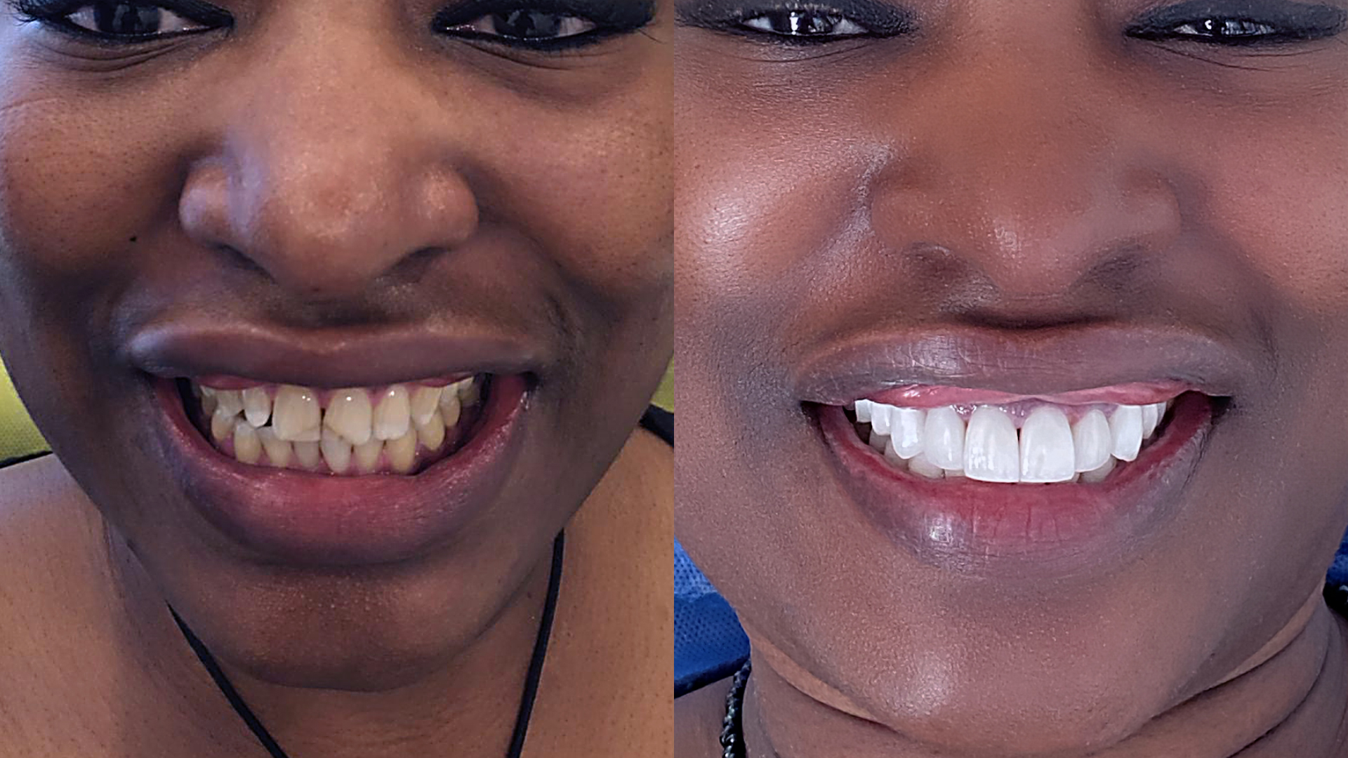 The results of a Hollywood Smile also called Smile Infinity.