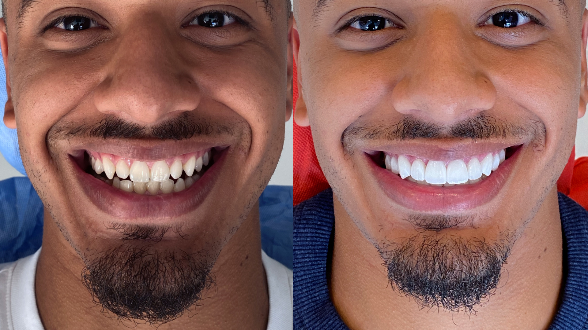 Résultat d’une intervention de dentisterie esthétique avec l’approche “Hollywood Smile” avec pose de facettes dentaires