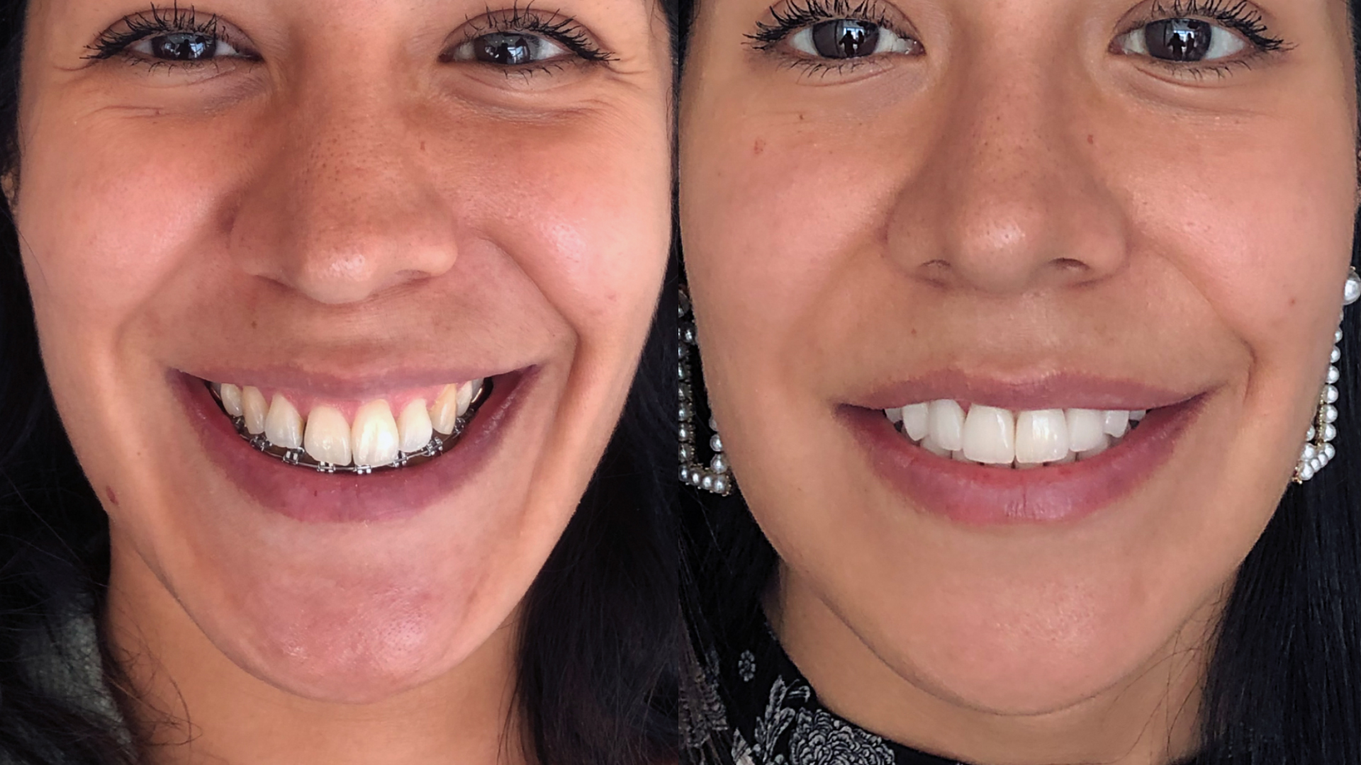 A picture of the same woman before and after a cosmetic dentistry procedure called “Hollywood Smile”