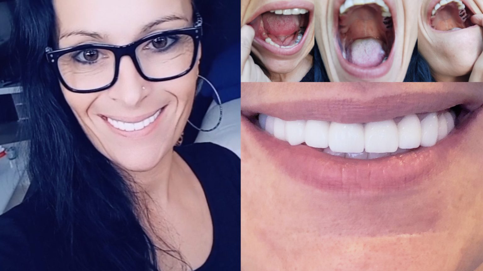 Dental bone graft what you need to know Body Expert