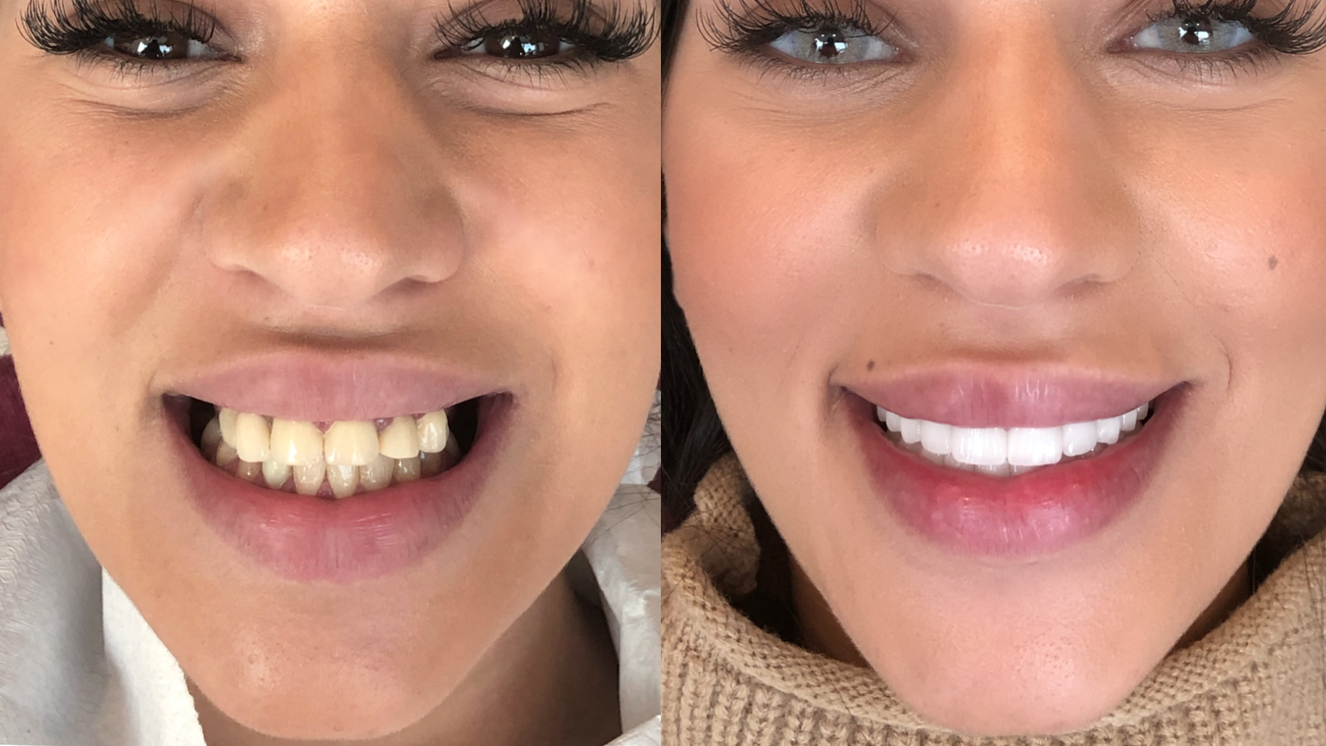 Before and after dental implant with dental bone grafting