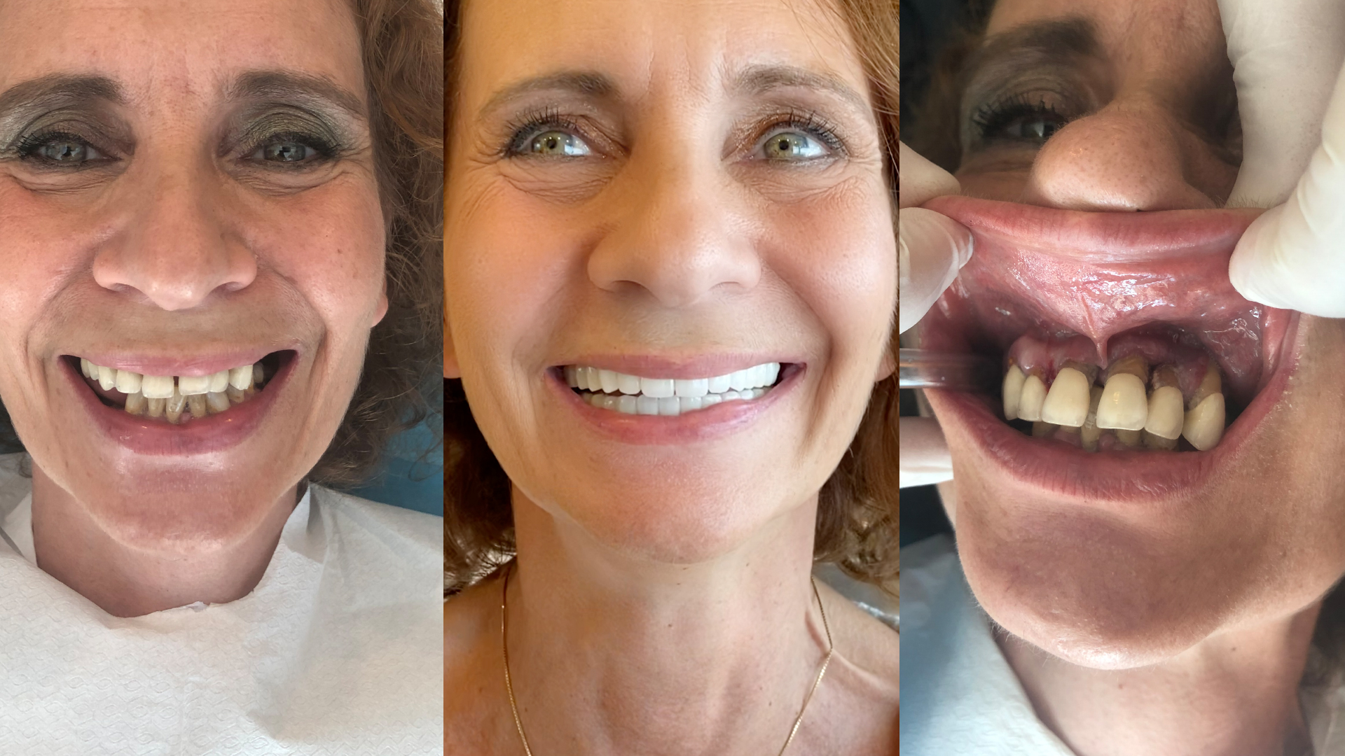 Dental implant with dental bone graft and veneers in Turkey