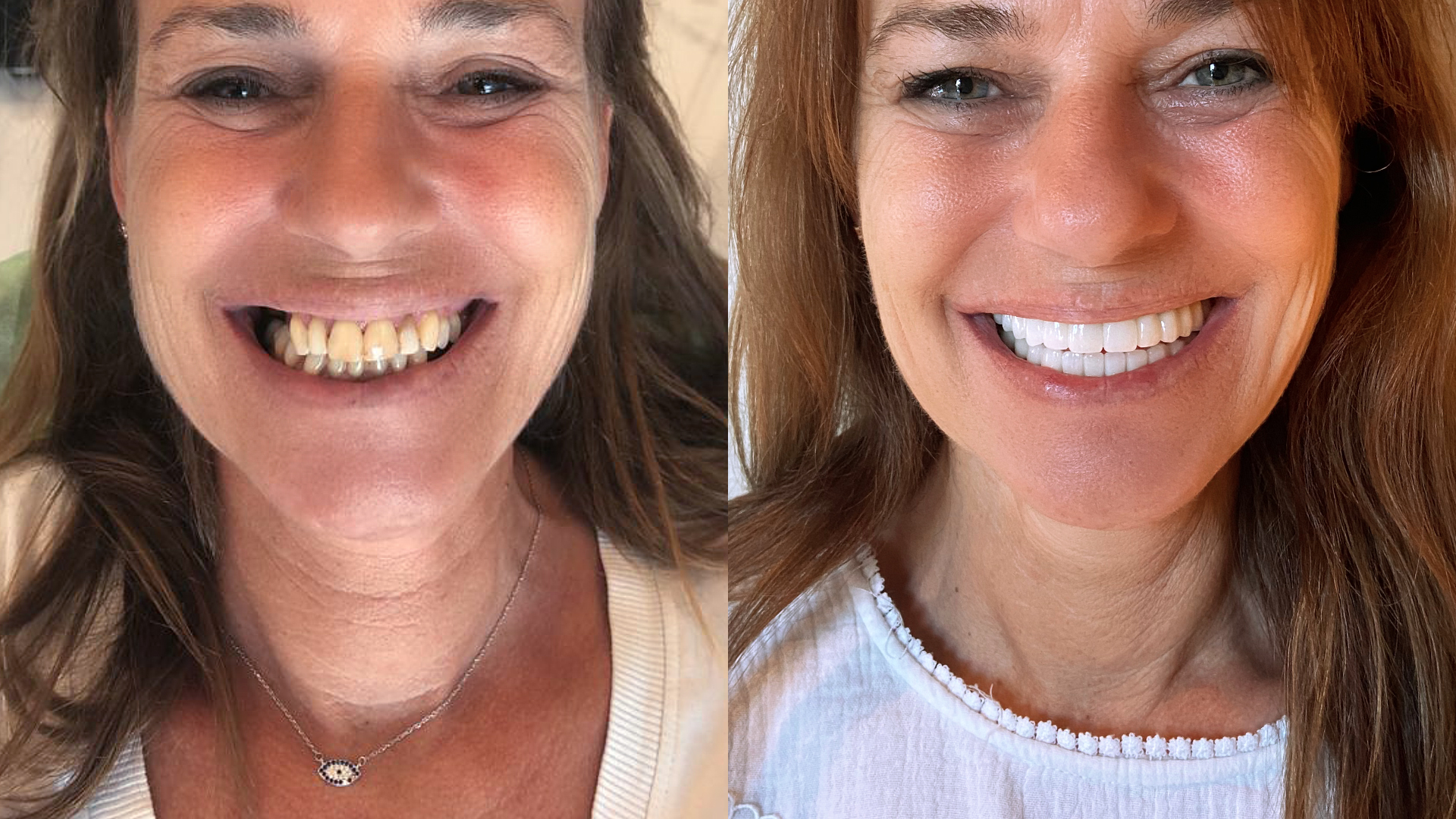 Dental bone grafting in Turkey results