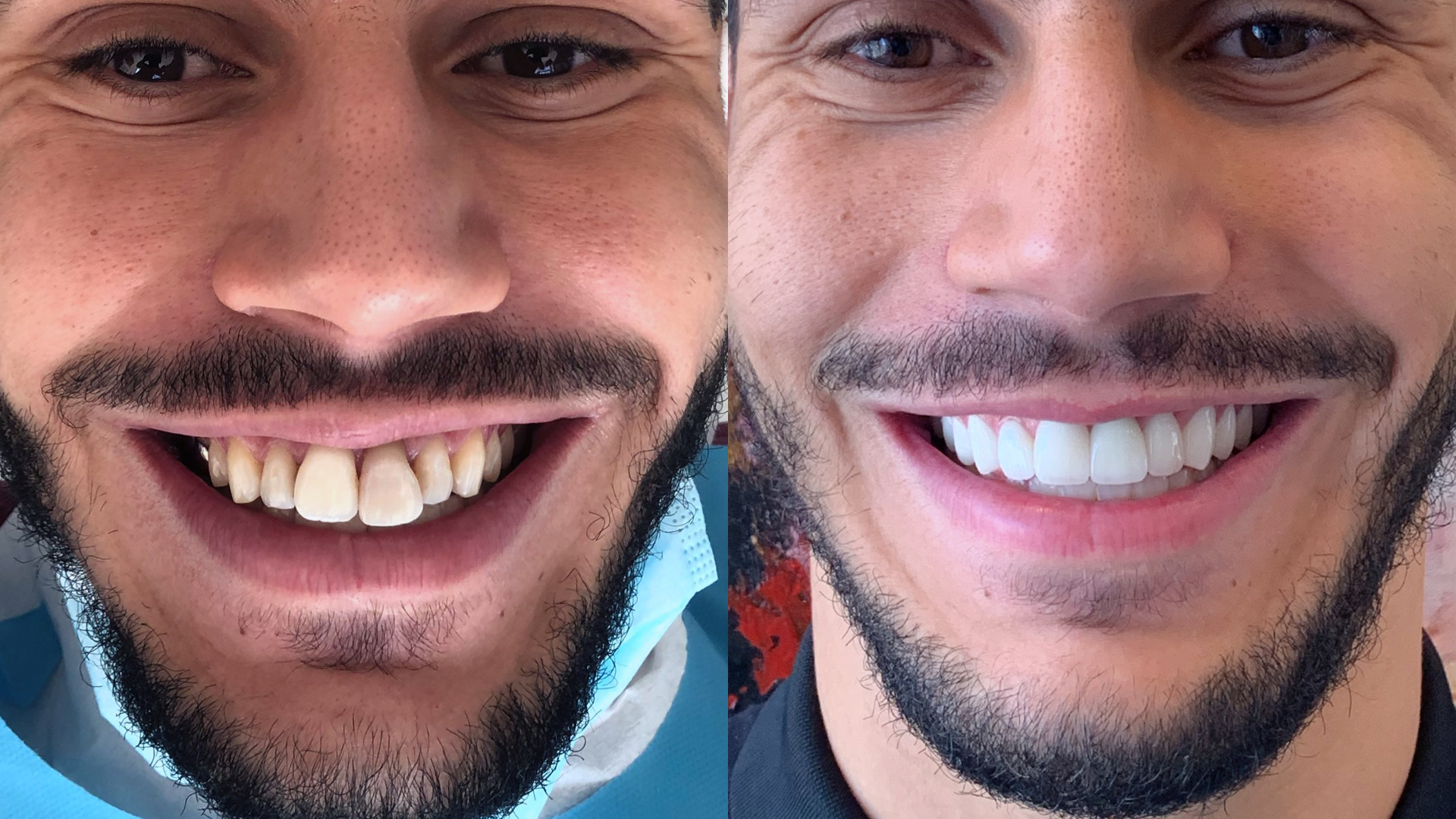 An example of a dental bone grafting with dental implants and veneers