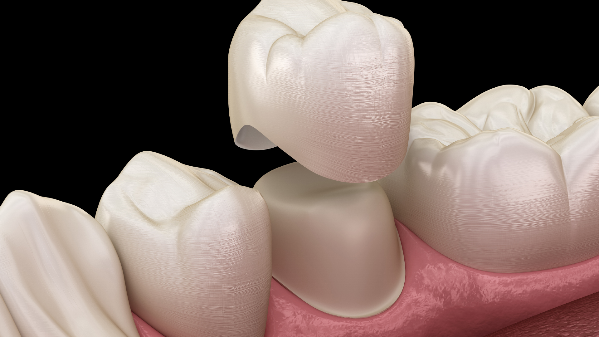 Modélisation 3D d’une couronne dentaire