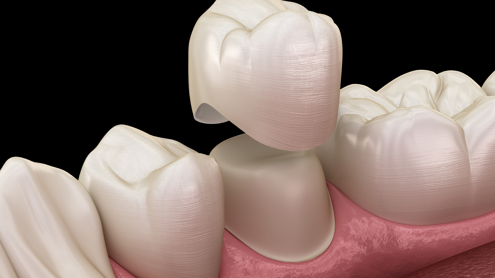 3D modelisation of a dental crown