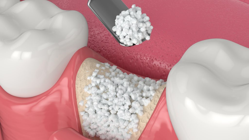 Bone Graft Wisdom Teeth: The Ultimate Guide to Successful Recovery