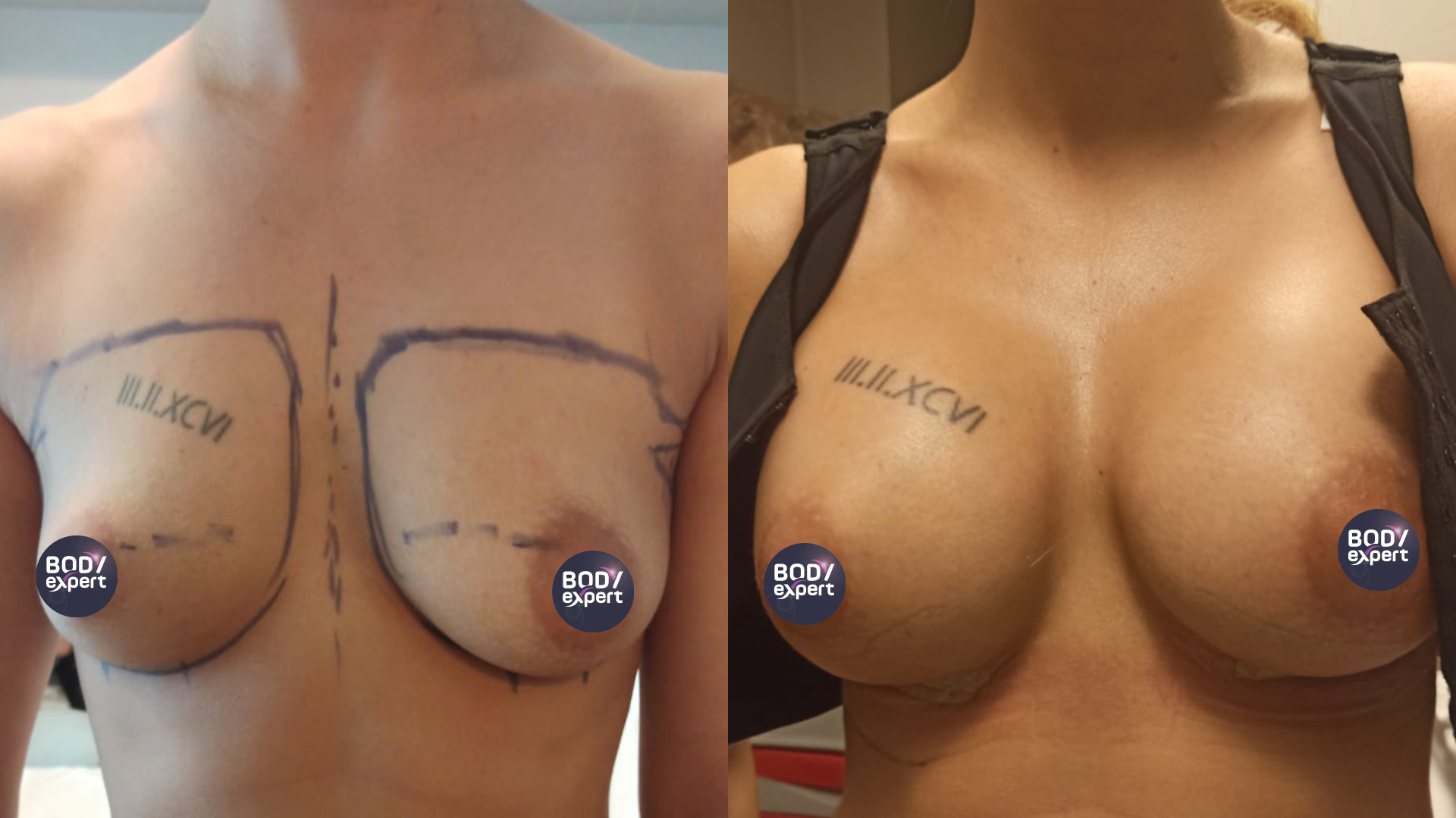 The results of a breast lift combined with a breast augmentation