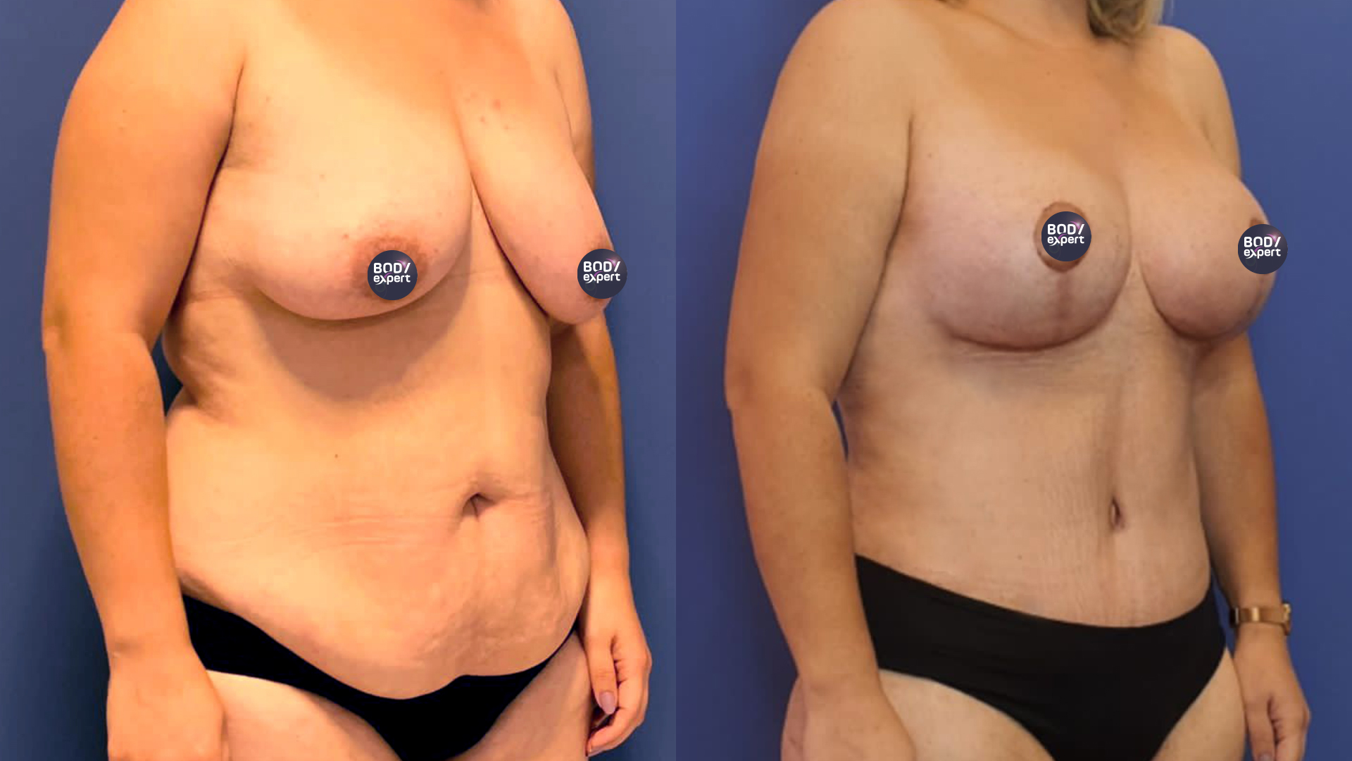The results of a mastopexy combined with a tummy tuck