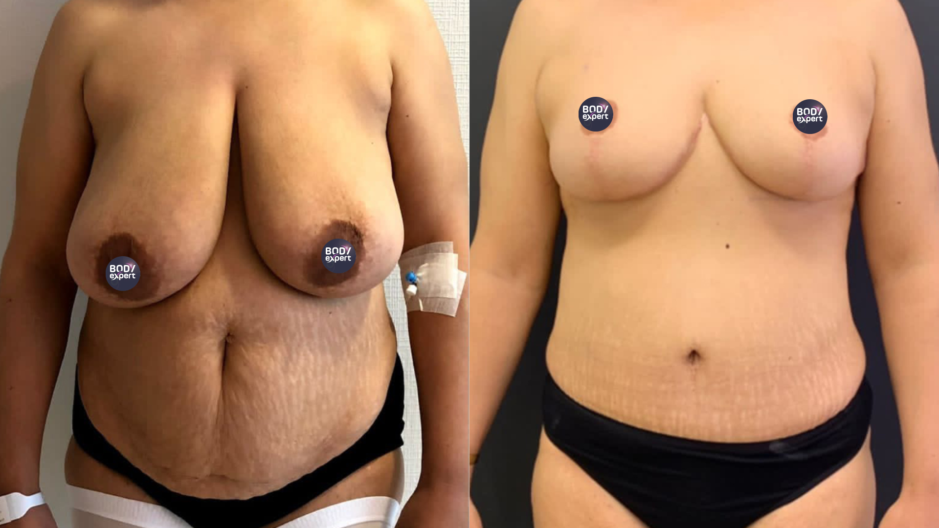 Une mastopexie combinée à une abdominoplastie : avant - après