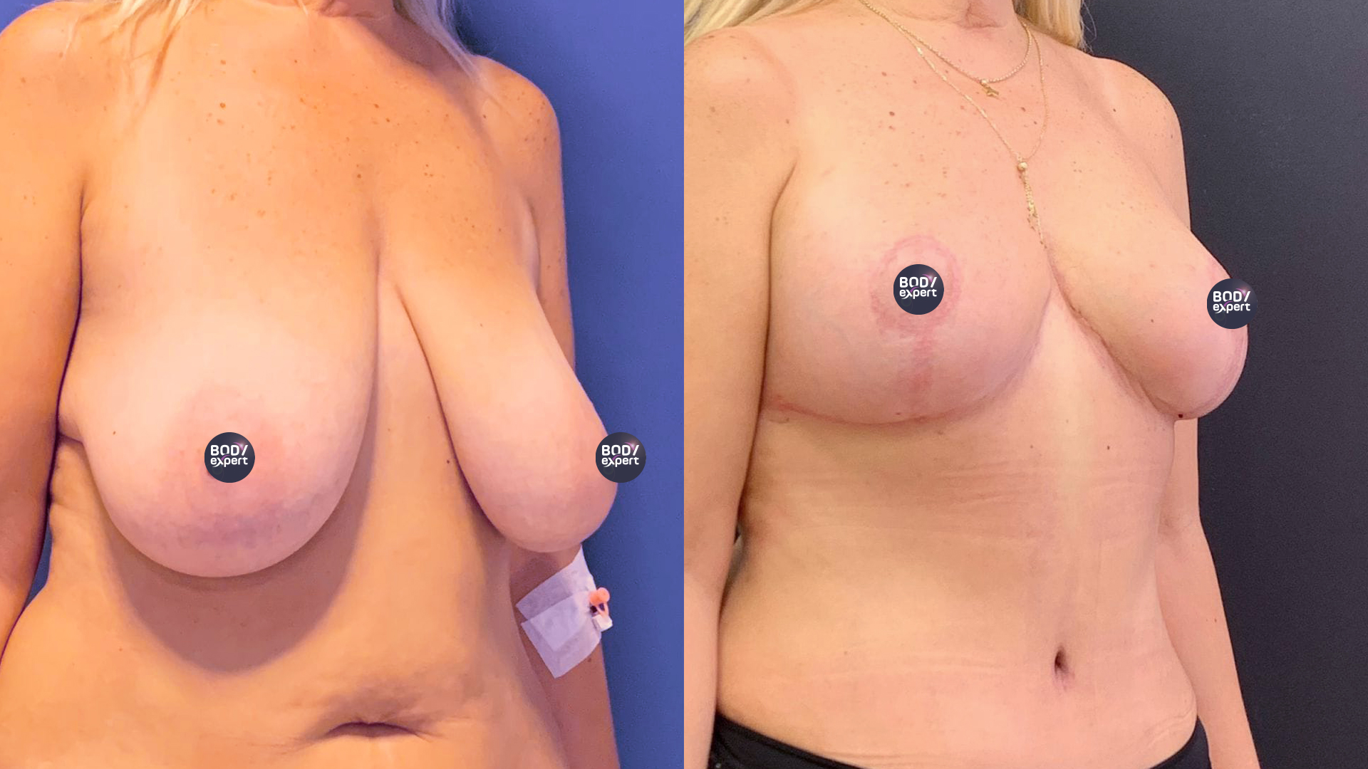 Breast lift and liposuction results