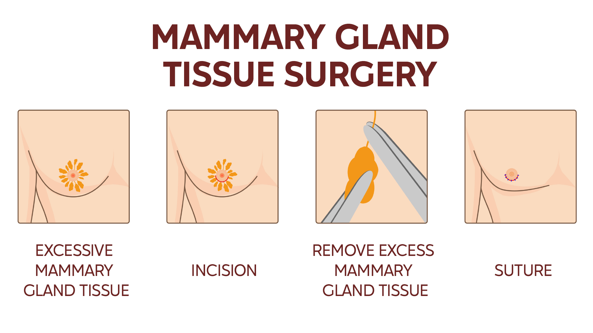 Mastectomy gynecomastia treatment procedure