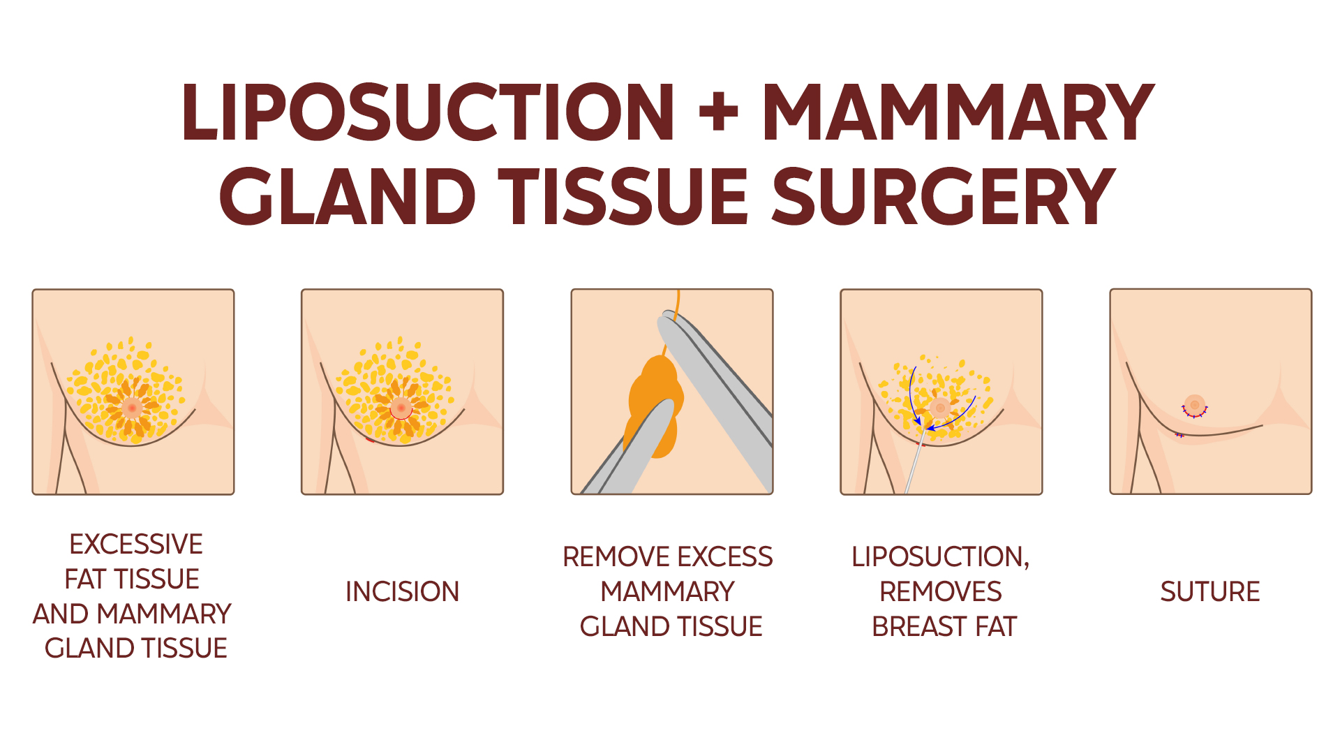 Liposuction and mastectomy gynecomastia treatment procedure
