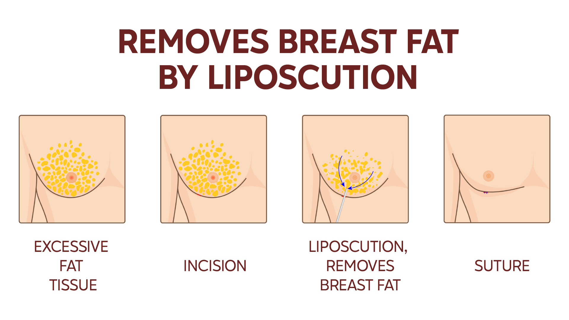 Liposuction gynecomastia treatment procedure