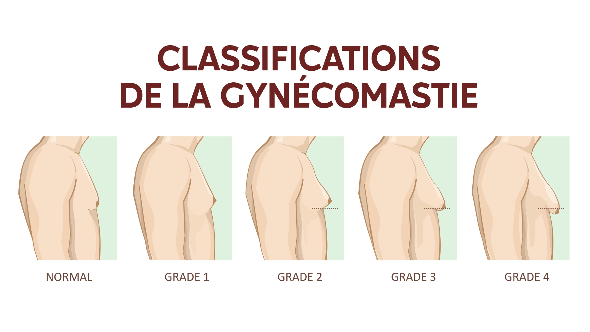 Classification des des gynécomastie