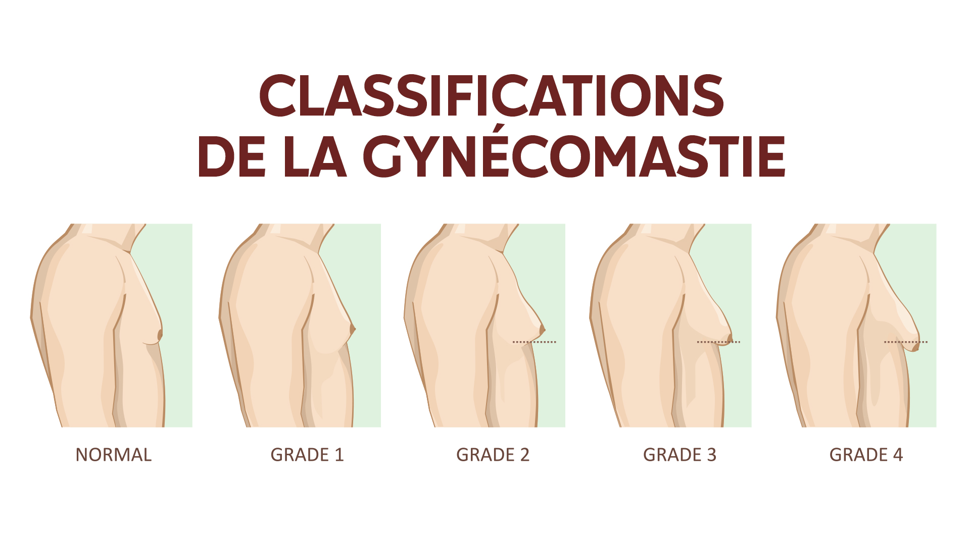 Traitement de la gynécomastie chez l'homme : prix, chirurgie ...