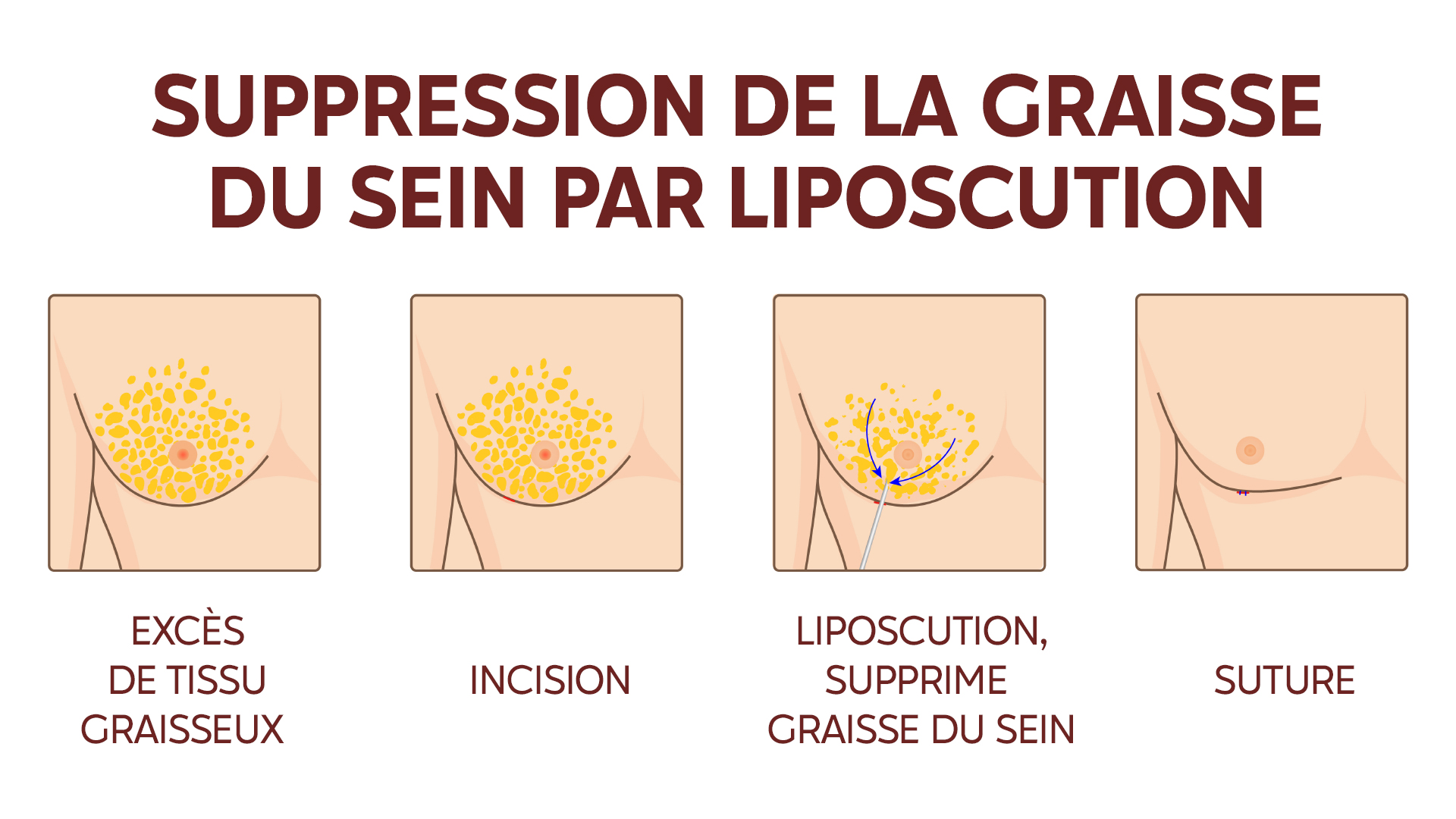 Étapes du traitement chirurgical de la gynécomastie par liposuccion