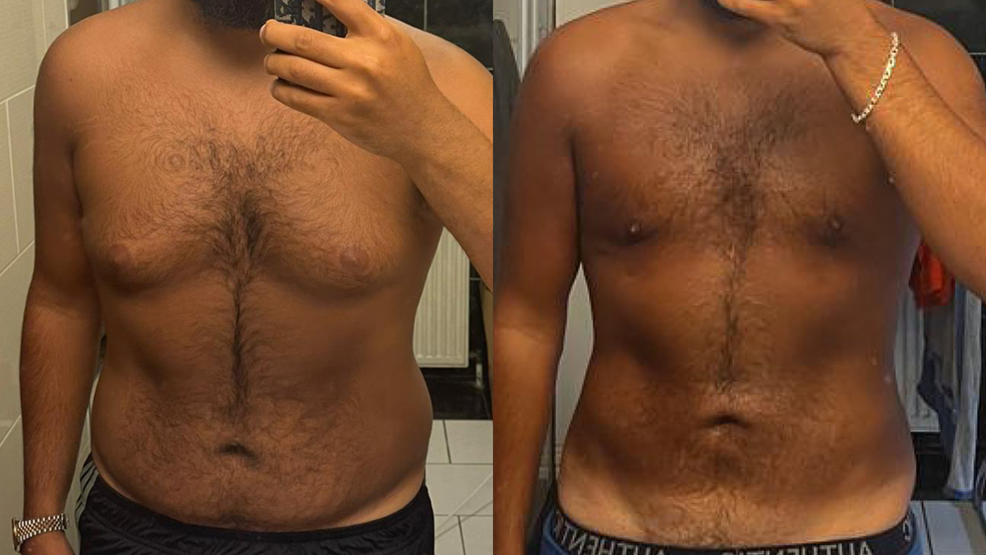 Gynecomastia treatment in Turkey : before / after