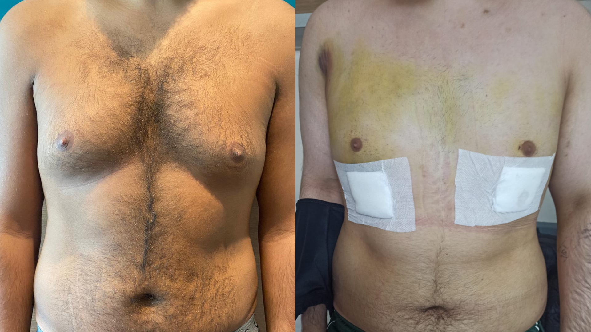 gynecomastia treatment before / after