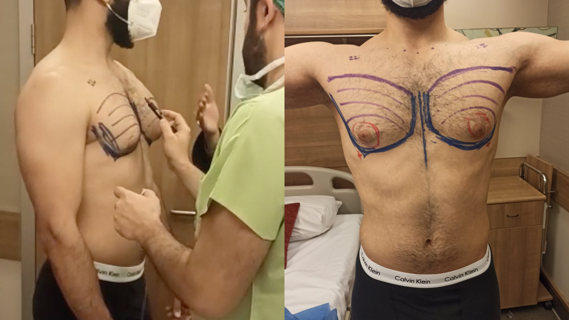 before a gynecomastia surgical treatment