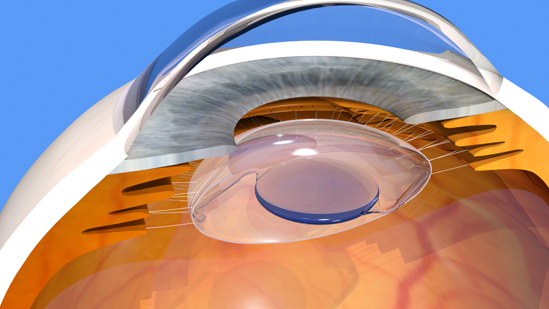 Modélisation 3D d'un implant oculaire