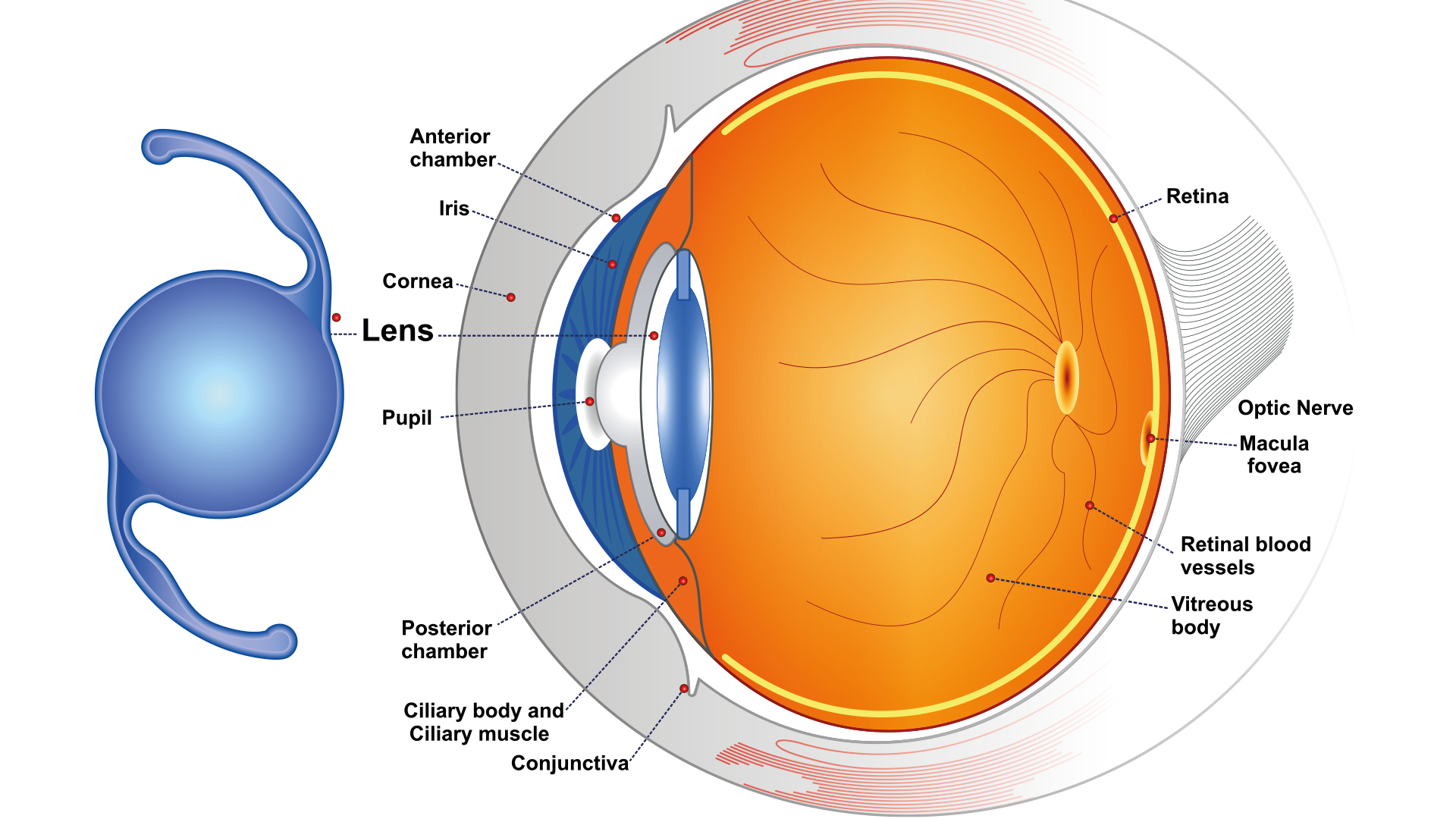 Schéma d'un implant multifocal implanté dans un œil