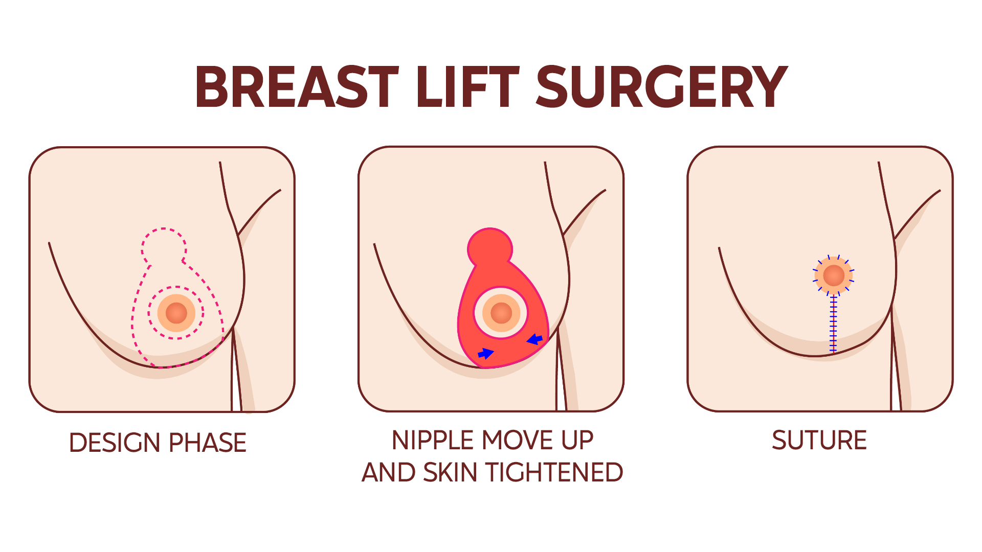 breast lift surgery phases